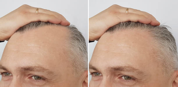 Finasteride for Hair Loss