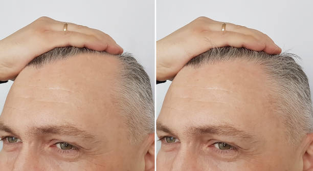 Finasteride for Hair Loss