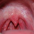 Cobblestone Throat