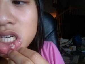 What Is The White Stuff In A Canker Sore