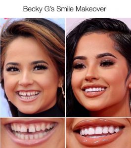 Becky G Teeth before and after