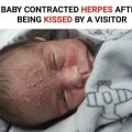 Baby Contracted Herpes After Being Kissed By A Visitor