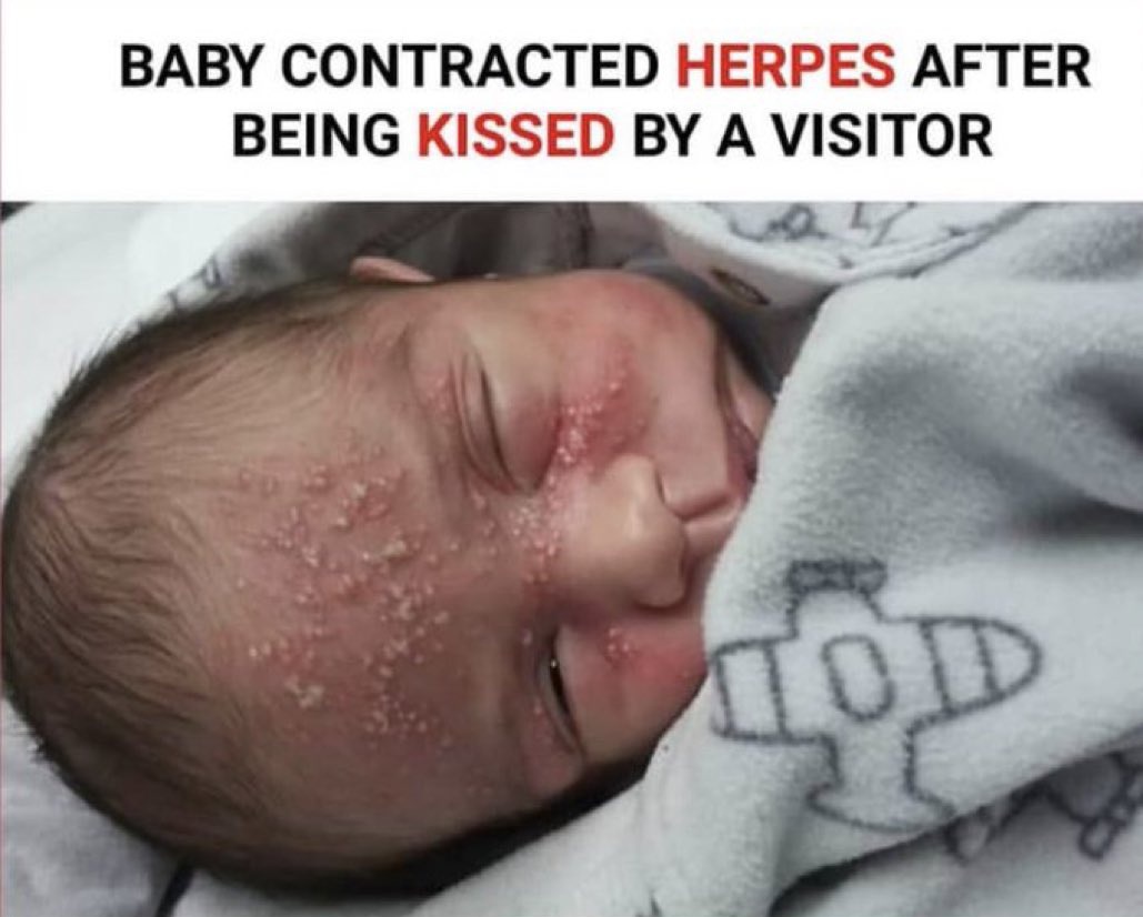 Baby Contracted Herpes After Being Kissed By A Visitor 