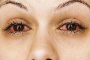 What Is Commonly Misdiagnosed As Pink Eye