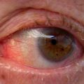 Glaucoma: A Hidden Threat to Vision Health Rising Swiftly