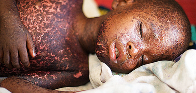 Measles Cases Surge Worldwide, Killing 136,000 Last Year